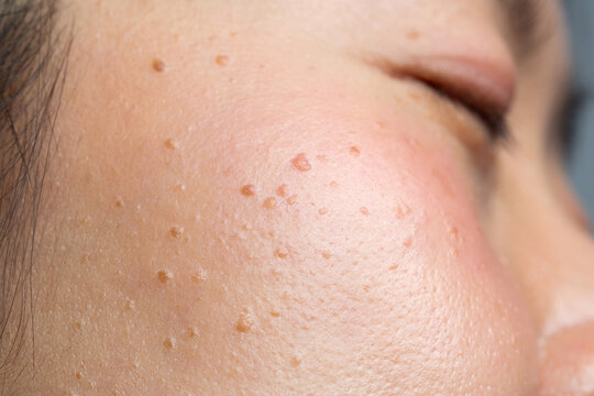 Closeup seborrheic keratosis, pore, acne and wrinkles in face woman skin macro. Facial care skin problems for beauty and cosmetic background concept.	