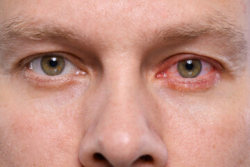 Man with red eye suffering from conjunctivitis, closeup