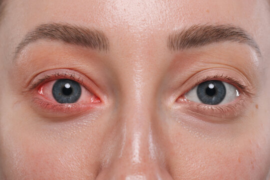 Woman with red eye suffering from conjunctivitis, closeup