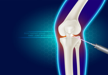 Laser treatment of knee joints Modern medical technology for treating joint injuries Reduce injuries and joint pain. Realistic vector illustration.