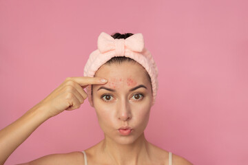 A young Caucasian brunette woman with a pink headband looking at camera and showing the pimples on...