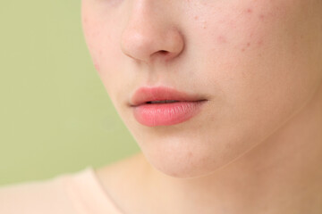 Beautiful young woman with acne problem on green background, closeup