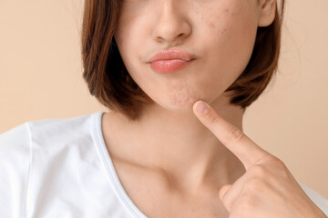 Beautiful young thoughtful woman with acne problem on beige background, closeup