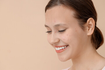 Beautiful young happy woman with acne problem on beige background