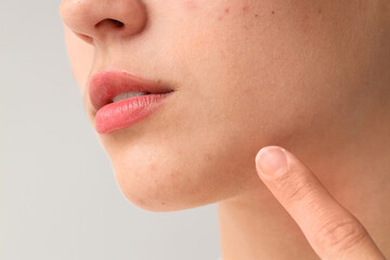 Beautiful young woman with acne problem pointing at her skin on grey background, closeup