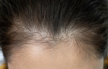 Cropped shot view of woman forehead with part of her thin hair, she had hair loss problem.