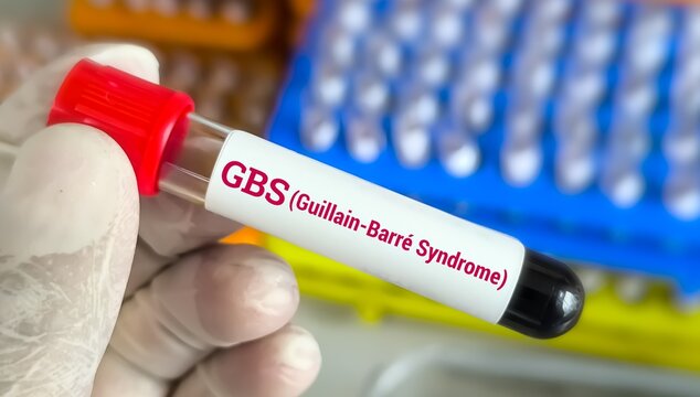 Guillain-Barre syndrome (GBS) test,  a rare disorder where the body's immune system damages nerve.
