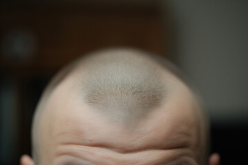 Close-up of Bald Scalp with Short Hair Growth - Detailed Portrait. AI Generated Photo