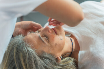 Close-up of facial acupuncture treatment to an elderly woman