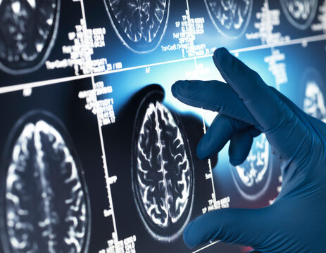 Neurology Research, Doctor examining a human brain scan on screen  