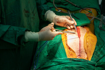Close up group of surgeons in Surgery operating room. Medical team of surgeons doing surgery in hospital operating.