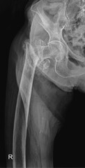 Digital Radiograph of Hip Fracture