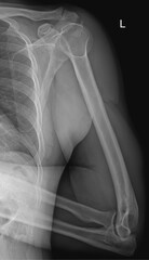 Fototapeta premium Precise X-ray Image of Human Elbow Joint and Ligaments