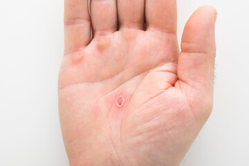 Young adult man palm with red callus after work on light gray table background. Closeup. Top down view.
