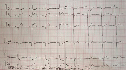 12 Lead ECG showing ST segment elevation in lead II, III and  aVF which represents Acute Inferior MI
