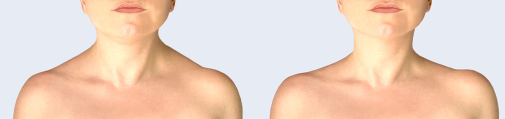 front of neck and shouledrs before and after botulinum toxin.