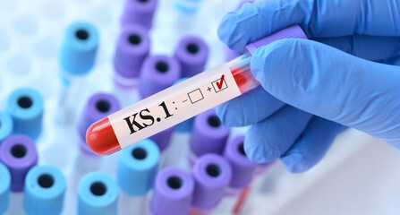 Doctor holding a test blood sample tube for the detection of the virus KS.1 on the background of...