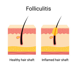 Folliculitis skin disease problem illustration