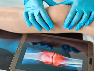 Doctor doing computer examination of knee joint using digital tablet