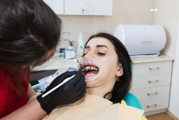  The process of installing.Dentistry, Smile design, White teeth.Restoration of teeth.