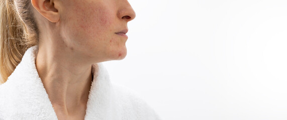 Design Cropped Face of Woman in her 30s with Acne Problem, Couperosis, Scarring, Blackheads....