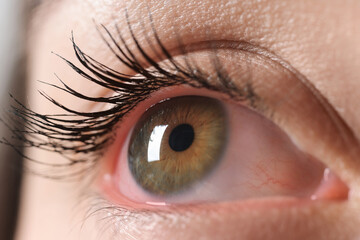 Woman with red eye suffering from conjunctivitis, closeup