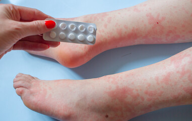 Woman hand with medicines and childrens legs with skin rash due to antibiotics alergy on light blue...