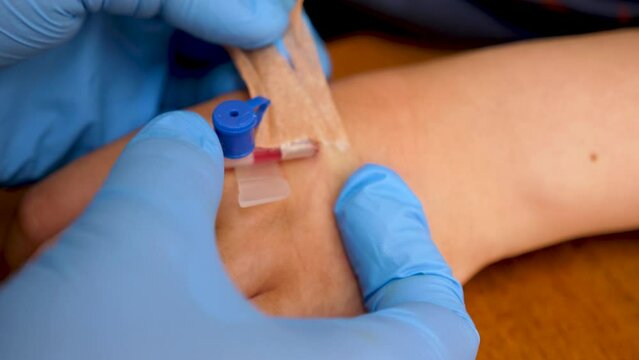A catheter is removed from a vein on the arm. Carrying out treatment procedures.slow motion