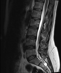 High-Resolution Lumbar Spine MRI Scan with Clear Vertebrae and Spinal Cord Details, Suitable for...