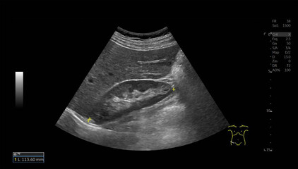 Kidney Ultrasound Images with Detailed Renal Structures, Perfect for Medical Education and...