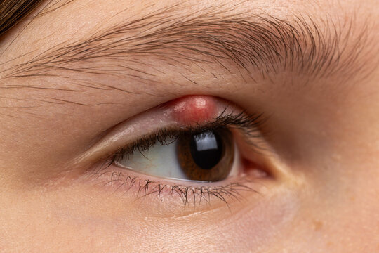 Chalazion on the eyelid of a girl close-up