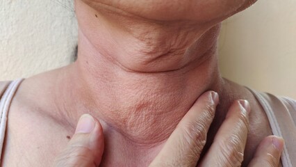 Portrait the wrinkle and Flabby skin under the chin, neck wattle and loose, Flabbiness and cellulitis on the body of middle aged 55 year old, health care and beauty concept.