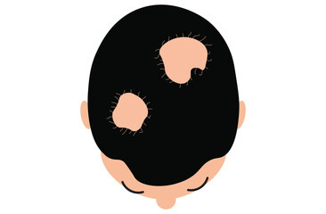 Alopecia areata is an autoimmune condition causing patchy hair loss on the scalp, face, and body. It occurs when the immune system attacks hair follicles, leading to sudden, vector
