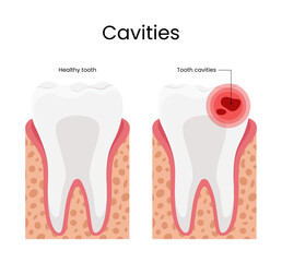 Cavities illustration healthy tooth and tooth cavities