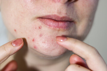 Close up of female face with red problematic acne skin