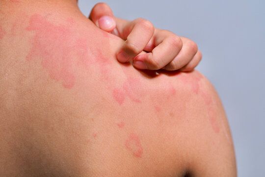 Skin texture suffering severe urticaria or hives or kaligata. Allergy symptoms.