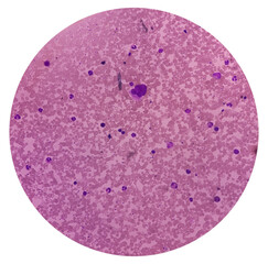 Bone marrow study (BMS). Chronic hyper eosinophilic syndrome. Hypo and hyper granular eosinophilic...