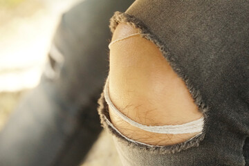 Close up Knee Skin with Torn Jean