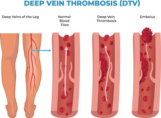 illustration of deep vein thrombosis diagram, DVT