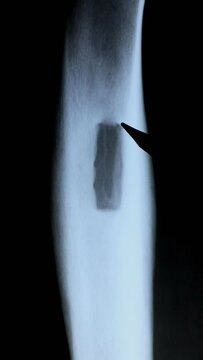 Doctor examining osteoid osteoma, benign bone tumor. X-ray and MRI, MRT, CT with marked sclerosis around the nidus. Medical treatmant concept. Diagnosis of the disease humans bones.