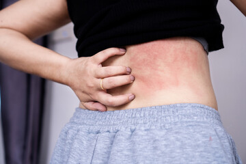 woman suffering from skin disease hand scratching on her back that redness and itchy due to allergy...
