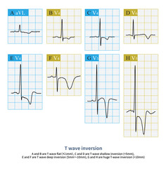 T wave inversion is a common ECG phenomenon, which can be a normal ECG phenomenon and is more common in structural heart disease.
