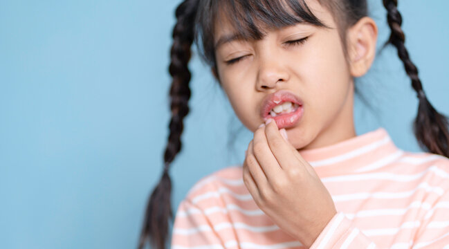 Little girl dry and peeling lips.Dry lips, peeling lips.