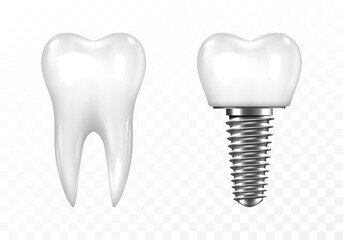 Human tooth and Dental implant on transparent background