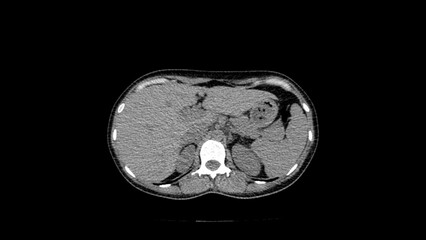 normal abdomen CT  scan 