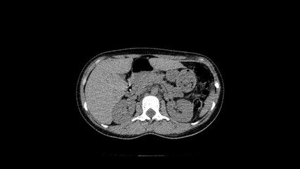 normal abdomen CT  scan 