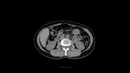normal abdomen CT  scan 