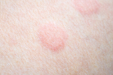 Skin allergy rash dermatitis texture close up