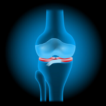 Knee meniscus injuries. knee joint anatomy