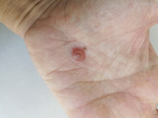 fly insect bite on hand. skin infection allergy